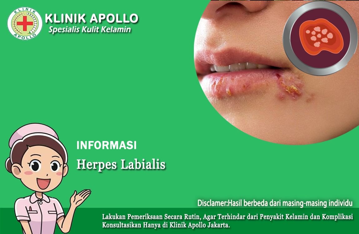 Kena Herpes Labialis? Yuk, Cari Tahu Pengobatan yang Tepat
