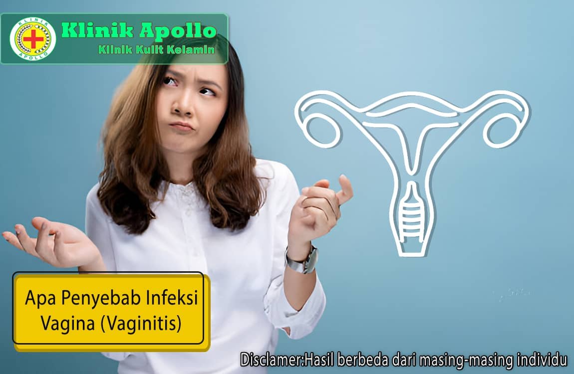 Ilustrasi Apa Sajakah Penyebab Infeksi Vagina (Vaginitis)?