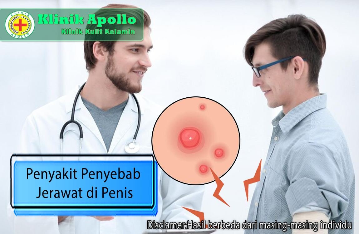 Ilustrasi Penyakit Penyebab Jerawat di Penis