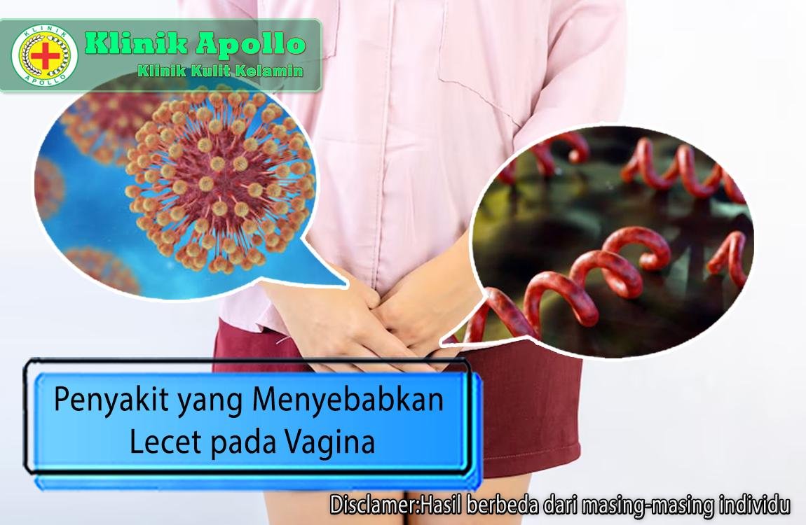 Ilustrasi Penyakit yang Menyebabkan Lecet pada Vagina